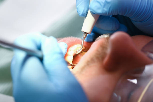 Best Emergency Treatment for Dental Infections or Abscesses in Carter, TX